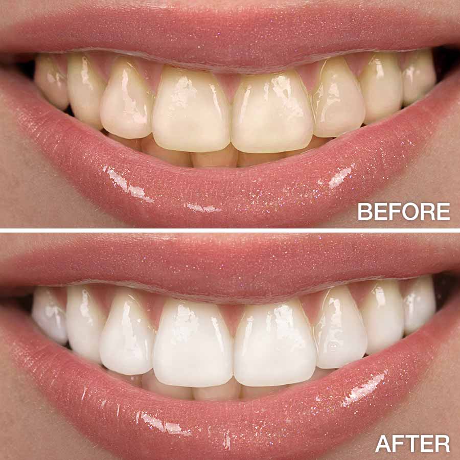 Teeth Whitening Strips | Depaysement™